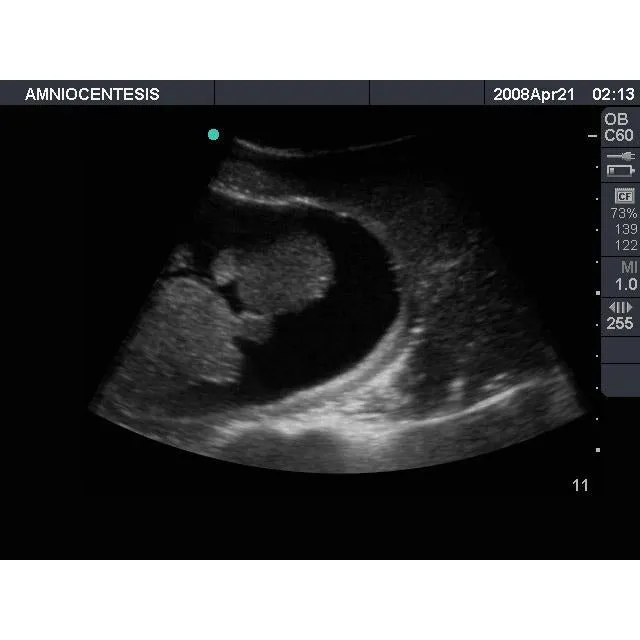 Amniocentesis Ultrasound Training Model