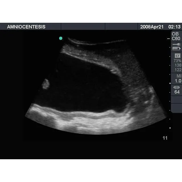 Amniocentesis Ultrasound Training Model